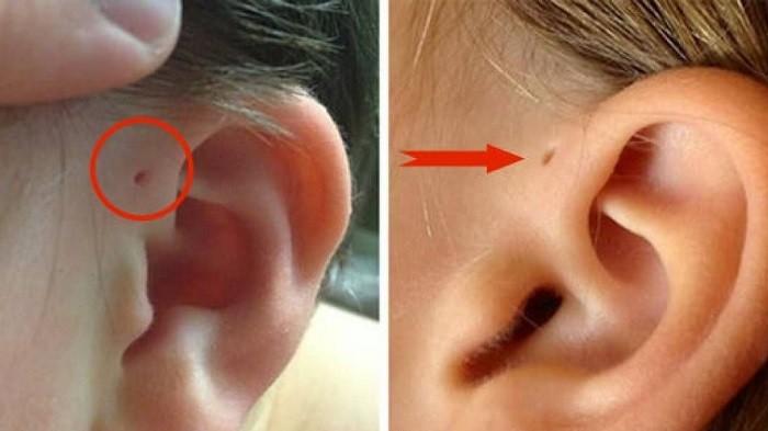 Perhatikan Apakah Ada Lubang Kecil di Atas Daun Telinga Anda? Jika Ya, Wajib Simak Penjelasan Ini